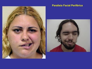 Paralisia facial periférica direita
Paralisia Facial Periférica
 