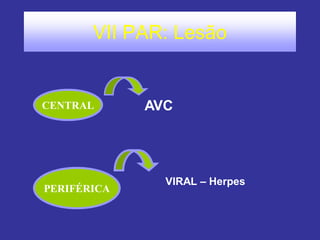 VII PAR: Lesão
CENTRAL AVC
PERIFÉRICA
VIRAL – Herpes
 