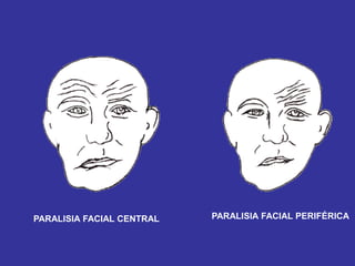 PARALISIA FACIAL CENTRAL PARALISIA FACIAL PERIFÉRICA
 