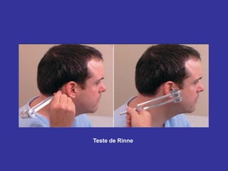 Teste de Rinne
 