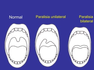 Normal Paralisia unilateral Paralisia
bilateral
 