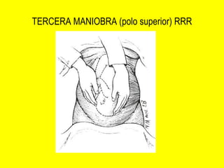TERCERA MANIOBRA (polo superior) RRR 