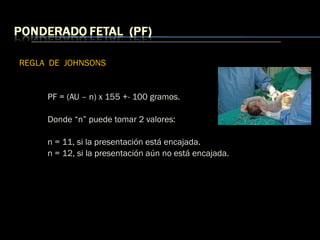 REGLA DE JOHNSONS
PF = (AU – n) x 155 +- 100 gramos.
Donde “n” puede tomar 2 valores:
n = 11, si la presentación está encajada.
n = 12, si la presentación aún no está encajada.
 
