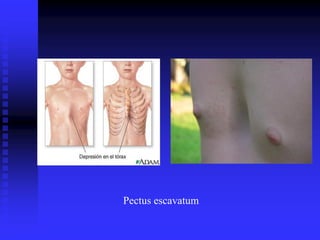 Pectus escavatum
 