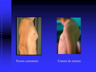 Pectus carinatum   Fratura de esterno
 