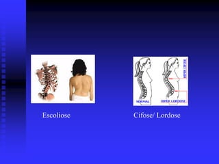 Escoliose   Cifose/ Lordose
 