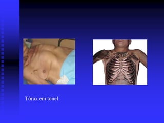 Tórax em tonel
 
