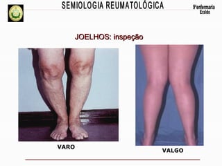 JOELHOS: inspeção

VARO

VALGO

 