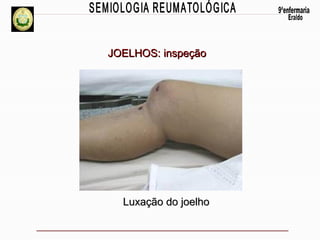 JOELHOS: inspeção

Luxação do joelho

 