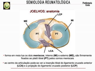 JOELHOS: anatomia

LCP
MI

ME

PT

PT

LCA
• forma em meia lua os dois meniscos, interno (MI) e externo (ME), são firmemente
fixados ao platô tibial (PT) pelos cornos meniscais
• ao centro da articulação pode-se ver a inserção tibial do ligamento cruzado anterior
(LCA) e a projeção do ligamento cruzado posterior (LCP)

 