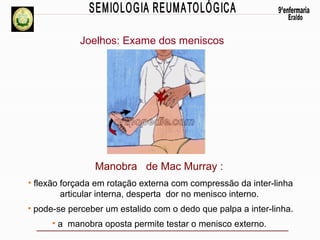 Joelhos: Exame dos meniscos

Manobra de Mac Murray :
• flexão forçada em rotação externa com compressão da inter-linha
articular interna, desperta dor no menisco interno.
• pode-se perceber um estalido com o dedo que palpa a inter-linha.
• a manobra oposta permite testar o menisco externo.

 