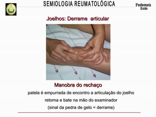Joelhos: Derrame articular

Manobra do rechaço
patela é empurrada de encontro a articulação do joelho
retorna e bate na mão do examinador
(sinal da pedra de gelo = derrame)

 
