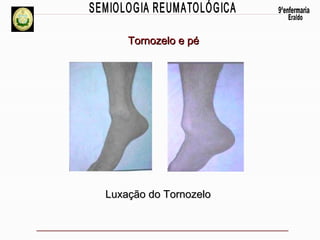 Tornozelo e pé

Luxação do Tornozelo

 