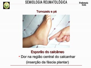 Tornozelo e pé

Esporão do calcâneo
• Dor na região central do calcanhar
(inserção da fáscia plantar)

 