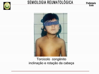 Torcicolo congênito
inclinação e rotação da cabeça

 