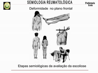 Deformidade no plano frontal

Etapas semiológicas da avaliação da escoliose

 