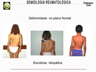 Deformidade no plano frontal

Escoliose idiopática

 
