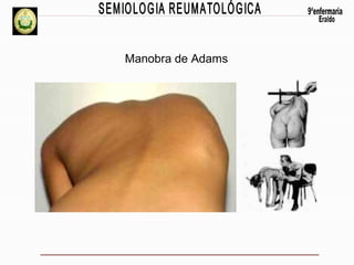 Manobra de Adams

 

 