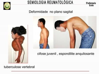 Deformidade no plano sagital

cifose juvenil , espondilite anquilosante

tuberculose vertebral

 