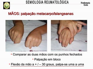 MÃOS: palpação metacarpofalangeanas

• Comparar as duas mãos com os punhos fechados
• Palpação em bloco
• Flexão da mão a + / – 30 graus, palpa-se uma a uma

 