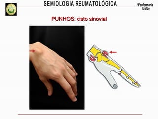 PUNHOS: cisto sinovial

 