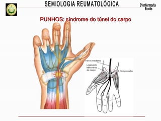 PUNHOS: síndrome do túnel do carpo

 