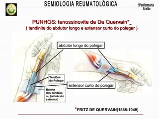 PUNHOS: tenossinovite de De Quervain*
( tendinite do abdutor longo e extensor curto do polegar )

abdutor longo do polegar

extensor curto do polegar

*FRITZ DE QUERVAIN(1868-1940)

 