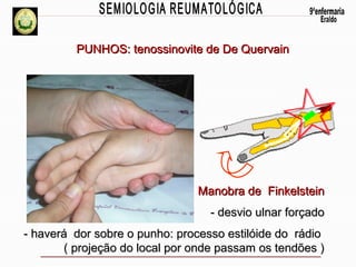 PUNHOS: tenossinovite de De Quervain

Manobra de Finkelstein
- desvio ulnar forçado
- haverá dor sobre o punho: processo estilóide do rádio
( projeção do local por onde passam os tendões )

 