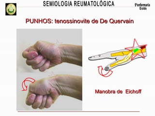 PUNHOS: tenossinovite de De Quervain

Manobra de Eichoff

 