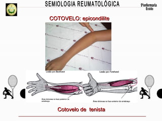 COTOVELO: epicondilite

Cotovelo de tenista

 