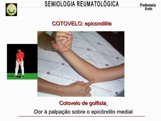 COTOVELO: epicondilite

Cotovelo de golfista
Dor à palpação sobre o epicôndilo medial

 