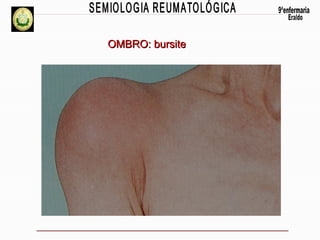 OMBRO: bursite

 
