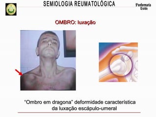 OMBRO: luxação

“Ombro em dragona” deformidade característica
da luxação escápulo-umeral

 