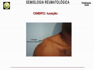 OMBRO: luxação

 