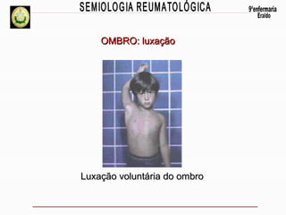 OMBRO: luxação

Luxação voluntária do ombro

 