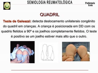 QUADRIL
Teste de Galeazzi: detecta deslocamento unilaterais congênito
do quadril em crianças. A criança é posicionada em DD com os
quadris fletidos a 90º e os joelhos completamente fletidos. O teste
é positivo se um joelho estiver mais alto que o outro.

 