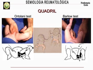 QUADRIL
Ortolani test

Barlow test

 