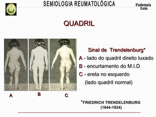 QUADRIL

Sinal de Trendelenburg*
A - lado do quadril direito luxado
B - encurtamento do M.I.D
C - ereta no esquerdo
(lado quadril normal)
A

B

C

*FRIEDRICH TRENDELENBURG
(1844-1924)

 
