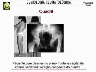 Quadril

Paciente com desvios no plano frontal e sagital da
coluna vertebral: luxação congênita do quadril

 