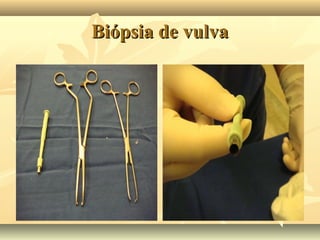 Biópsia de vulva

 