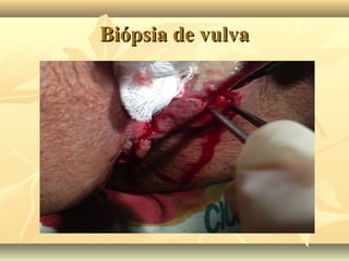 Biópsia de vulva

 