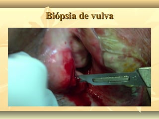 Biópsia de vulva

 