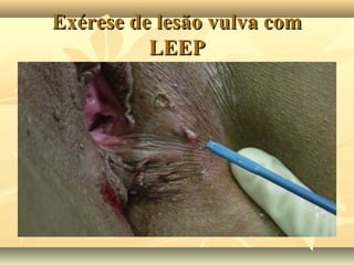 Exérese de lesão vulva com
LEEP

 