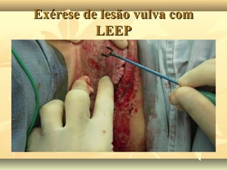 Exérese de lesão vulva com
LEEP

 