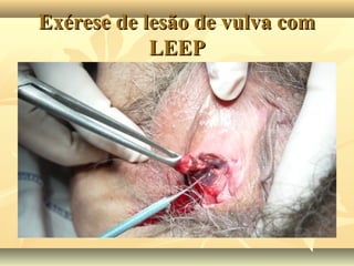 Exérese de lesão de vulva com
LEEP

 