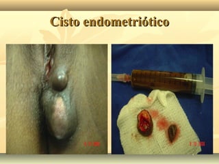 Cisto endometriótico

 