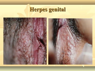 Herpes genital

 