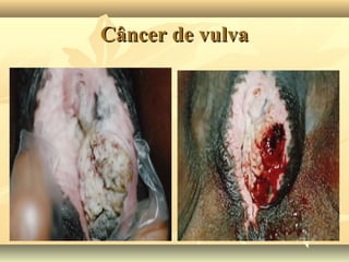 Câncer de vulva

 