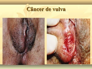 Câncer de vulva

 