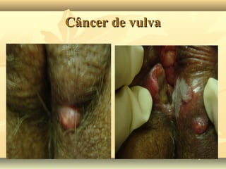 Câncer de vulva

 